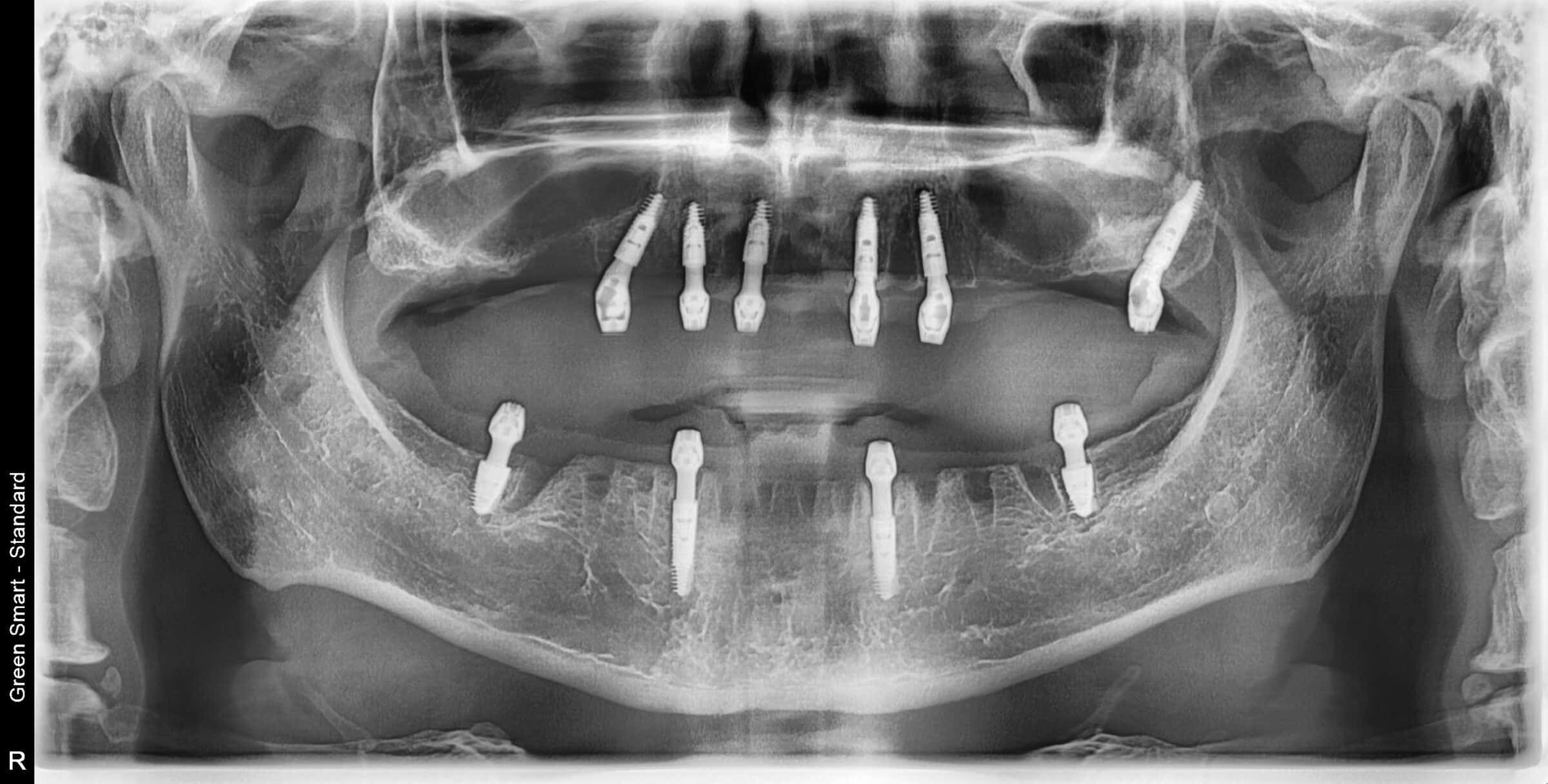 Radiografia della signora con mobilità grado 3